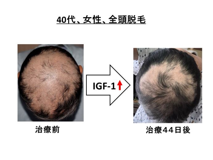 円形脱毛症　病院